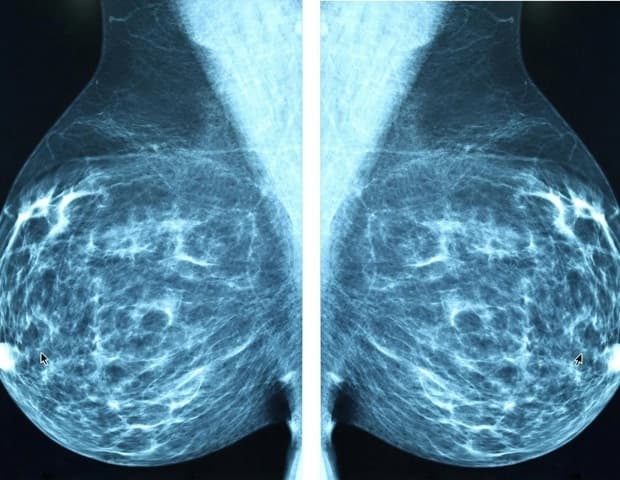 AI detects breast cancer earlier and more accurately in Dutch screening program - News-Medical